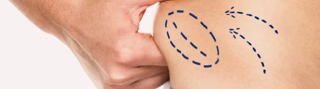 Liposuction Surgery
